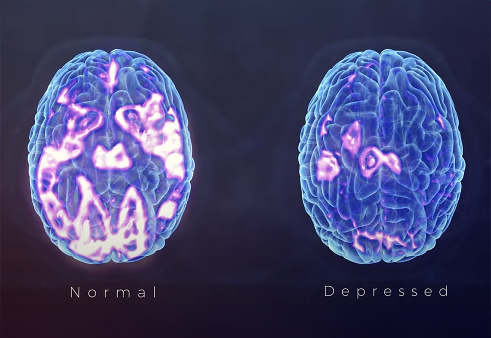 Normal brain vs. depressed brain